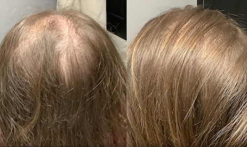 non surgical hair restoration mississauga before after alma ted